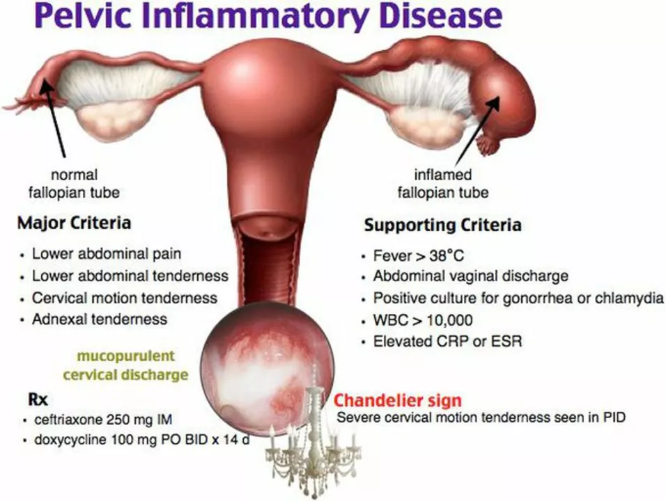 How azithromycin can help treat pelvic inflammatory disease